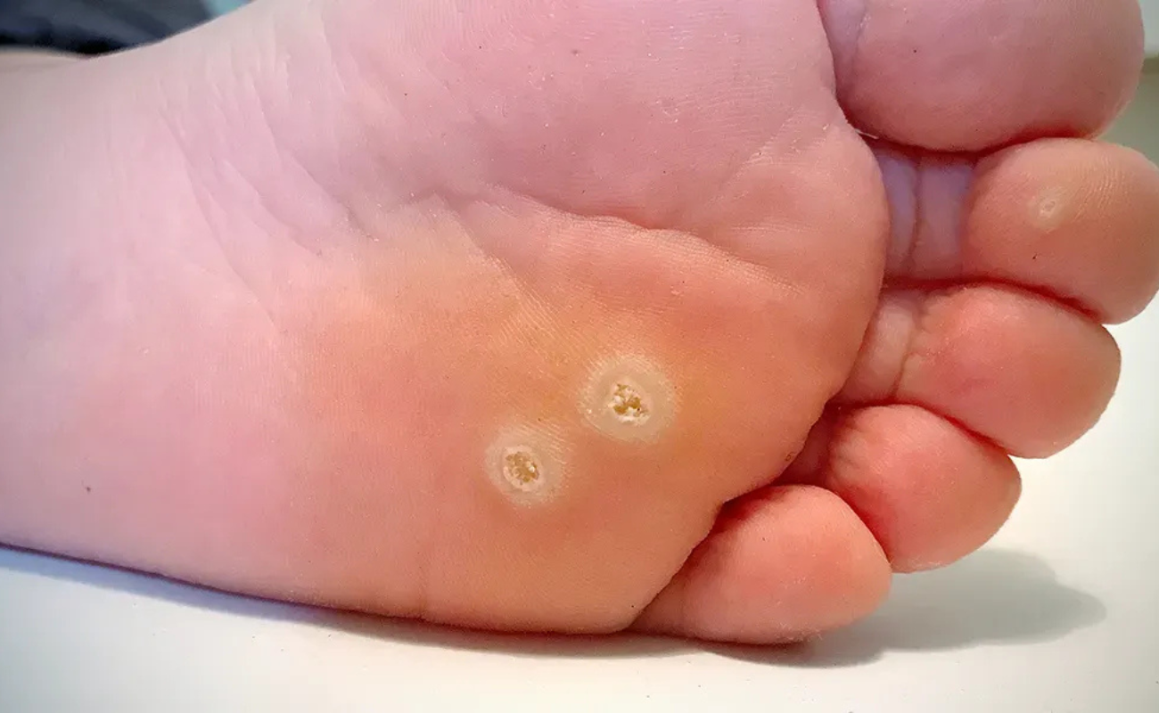 Plantar Warts