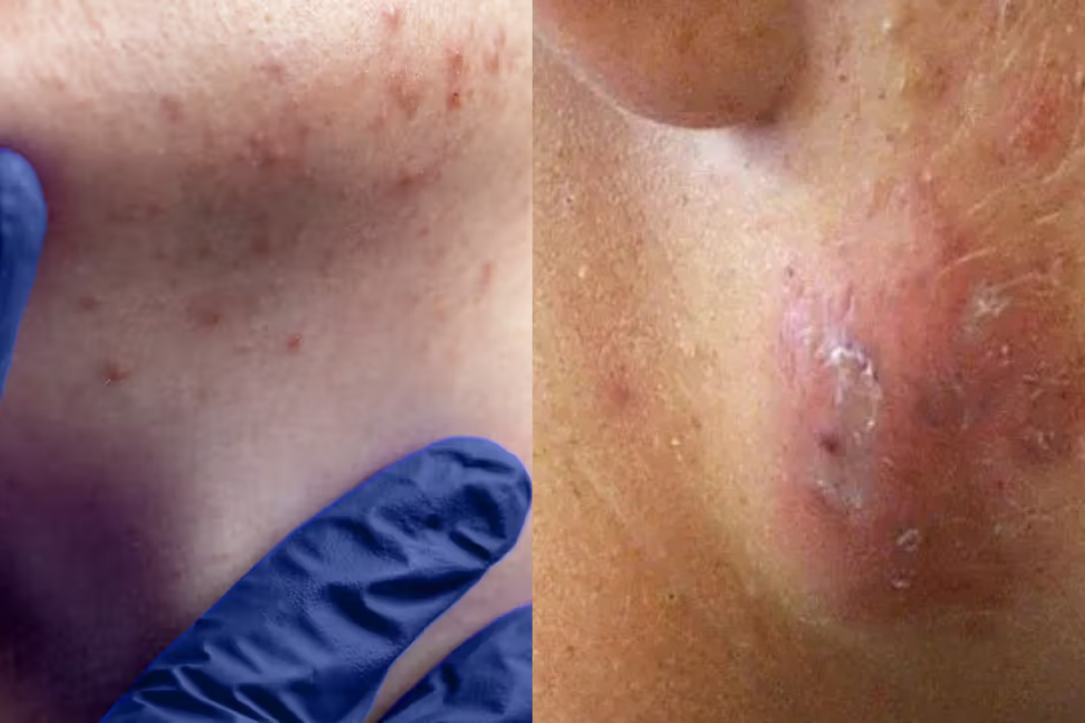 Hormonal Acne